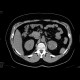 Tumour of the left adrenal gland, adenoma: CT - Computed tomography